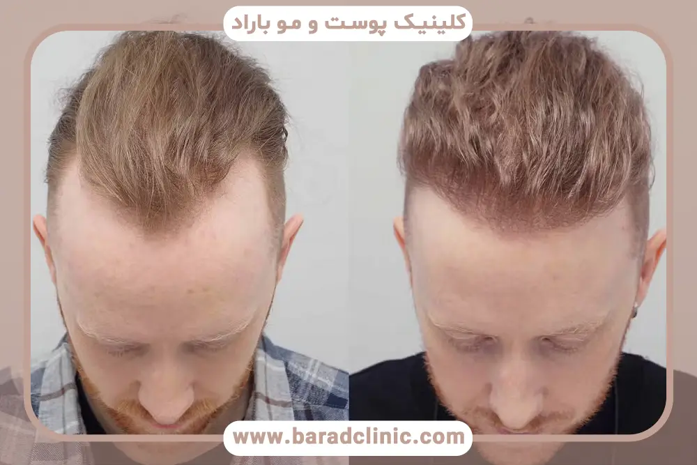 شب قبل از کاشت مو