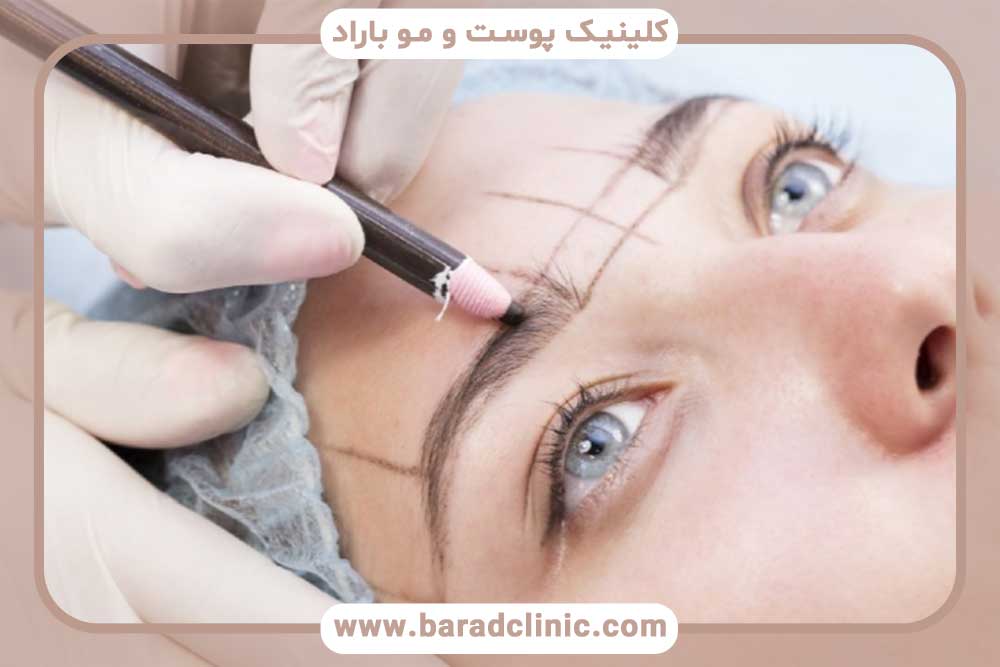 کاشت ابرو برای افراد مبتلا به آلوپسی