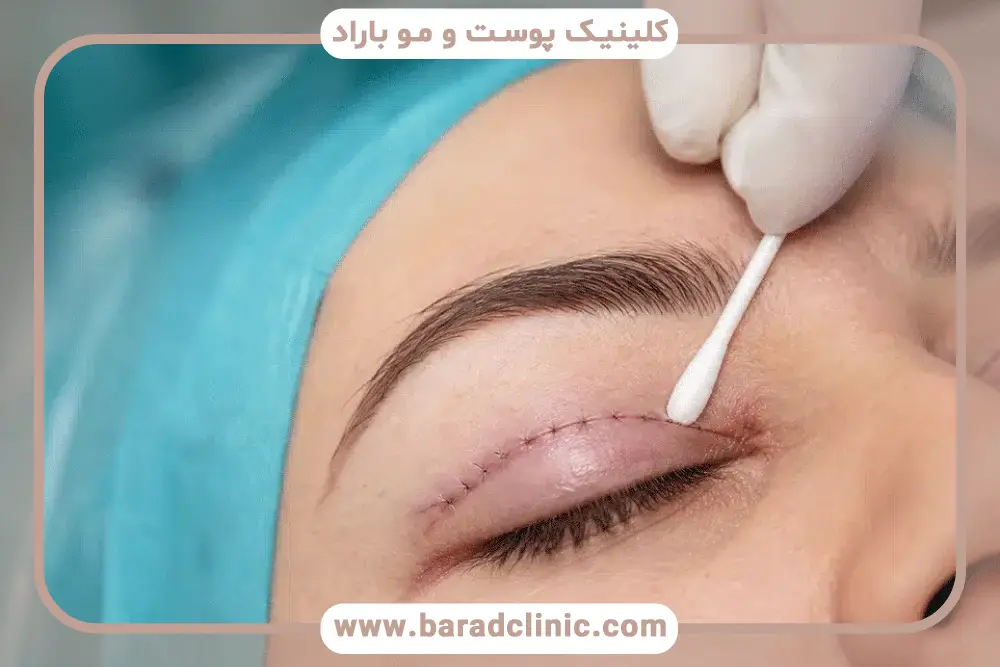دوره نقاهت عمل بلفاروپلاستی
