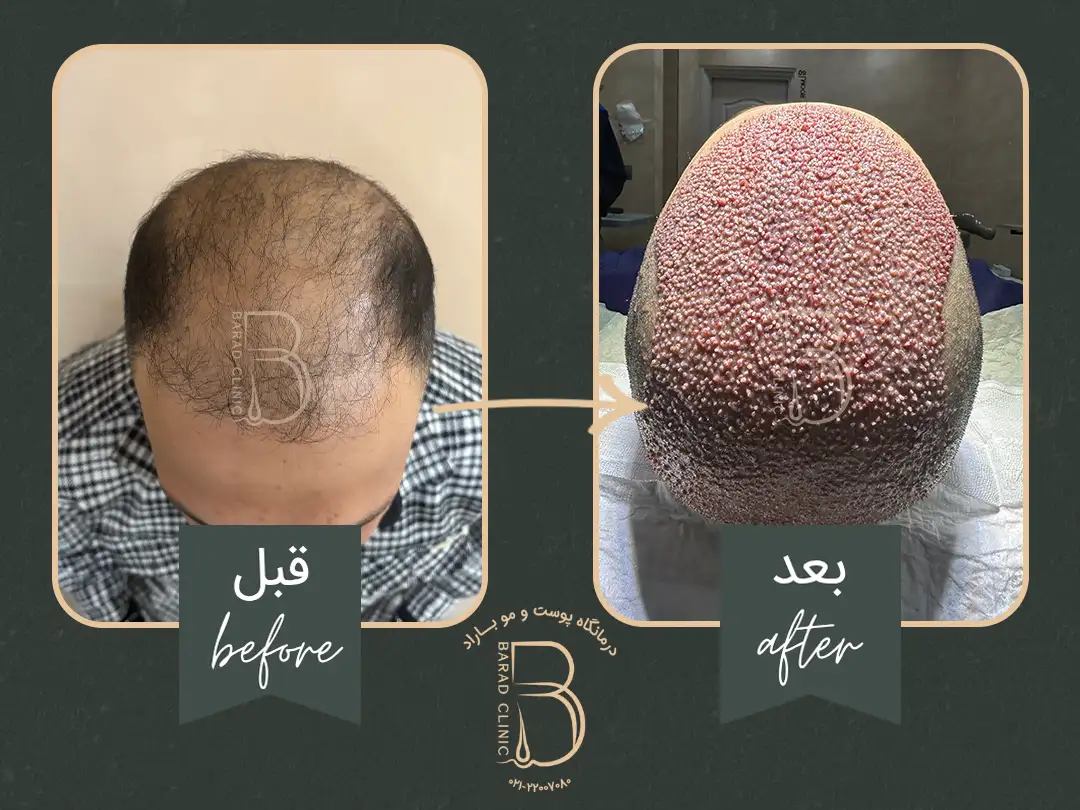کاشت مو پرتراکم در کلینیک باراد