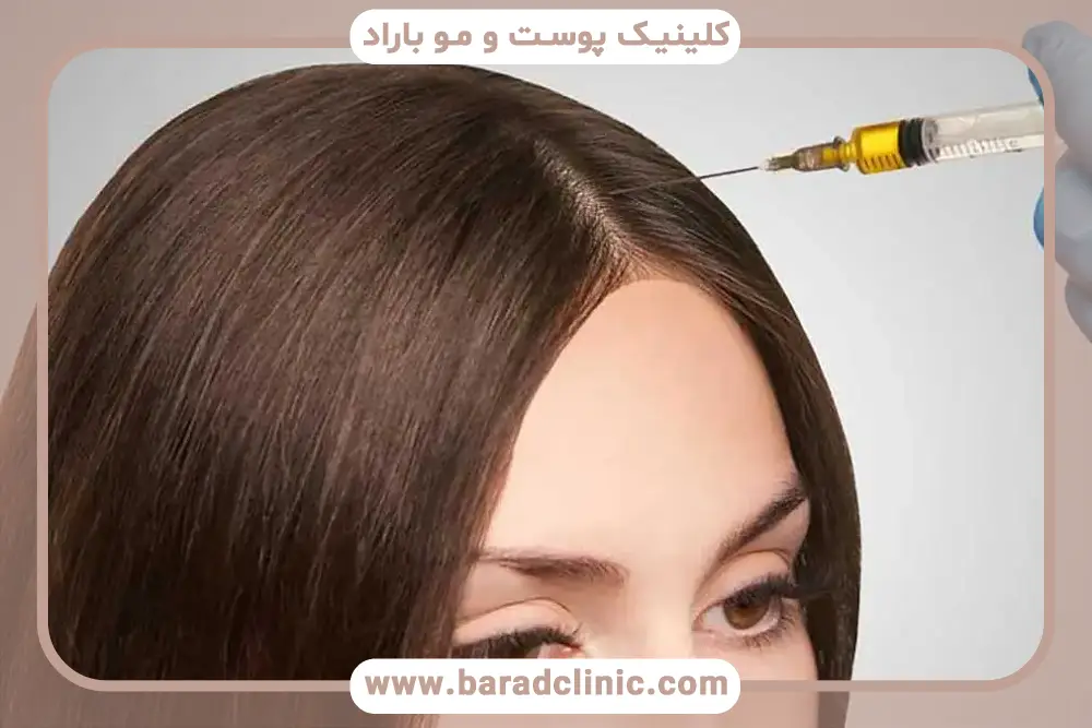 پی آر پی مو بهتر است یا مزوتراپی؟ بررسی پی آر پی