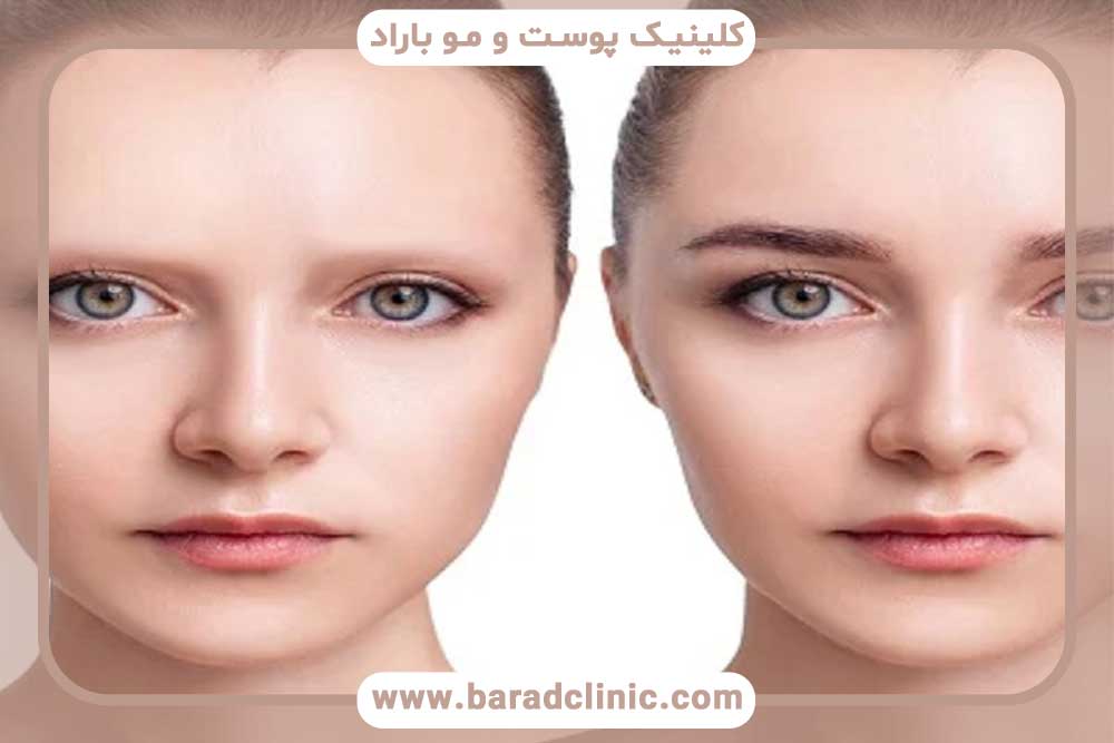 کاشت ابرو بعد از درمان سرطان