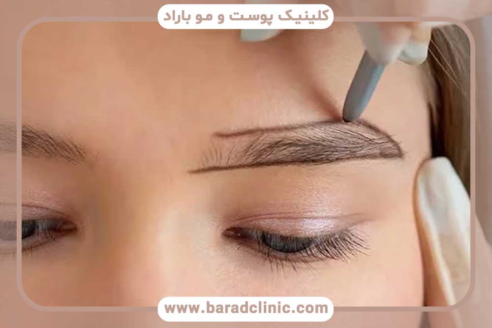 کاشت ابرو