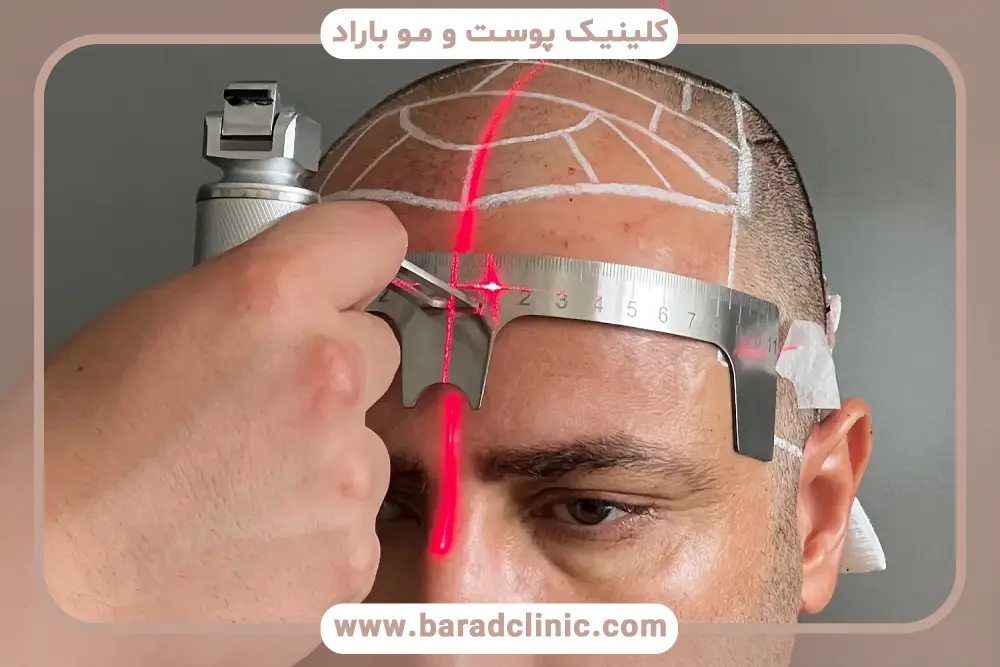 بررسی کاشت مو با دستگاه تمام اتوماتیک تهران