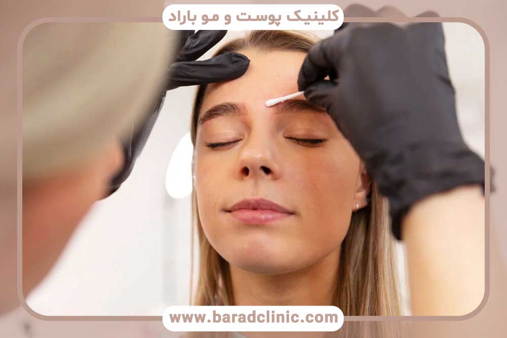 کاشت ابرو