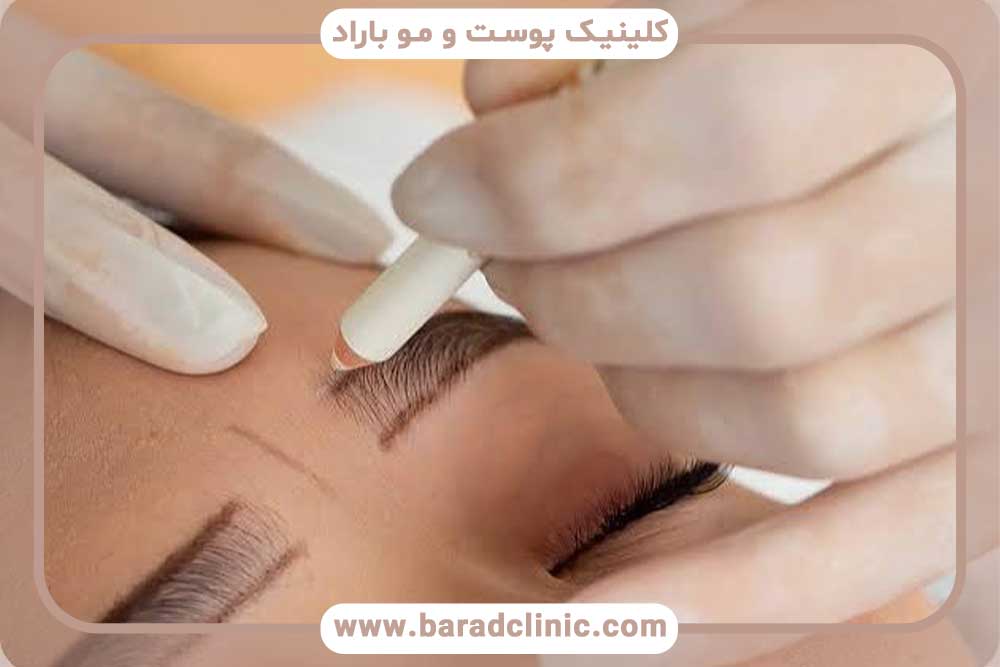بهترین دکتر کاشت ابرو