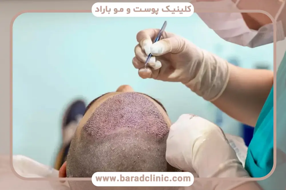 میانگین هزینه کاشت مو با تراکم بالا