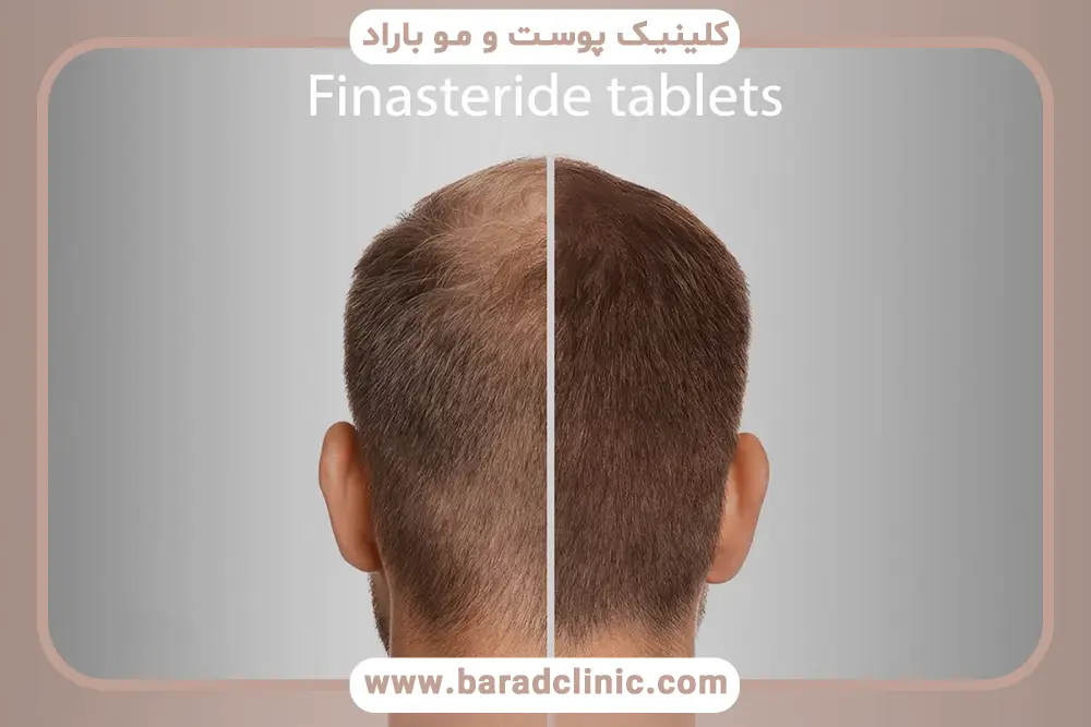 اهمیت قرص برای کاشت مو 