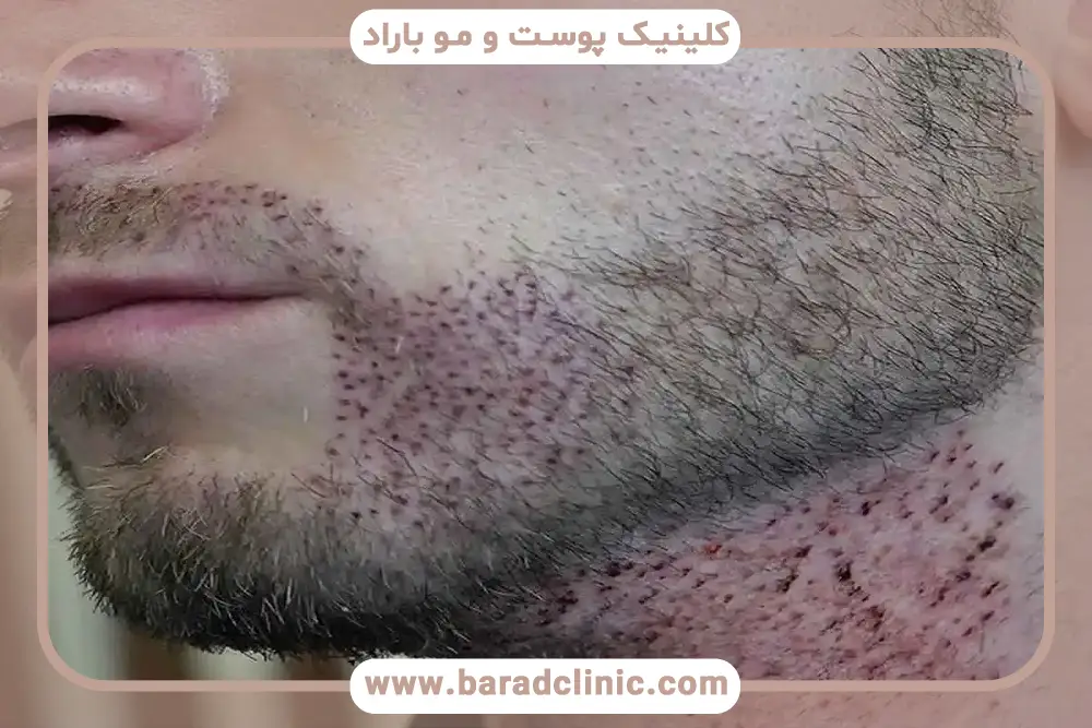 جای زخم کاشت ریش چیست؟