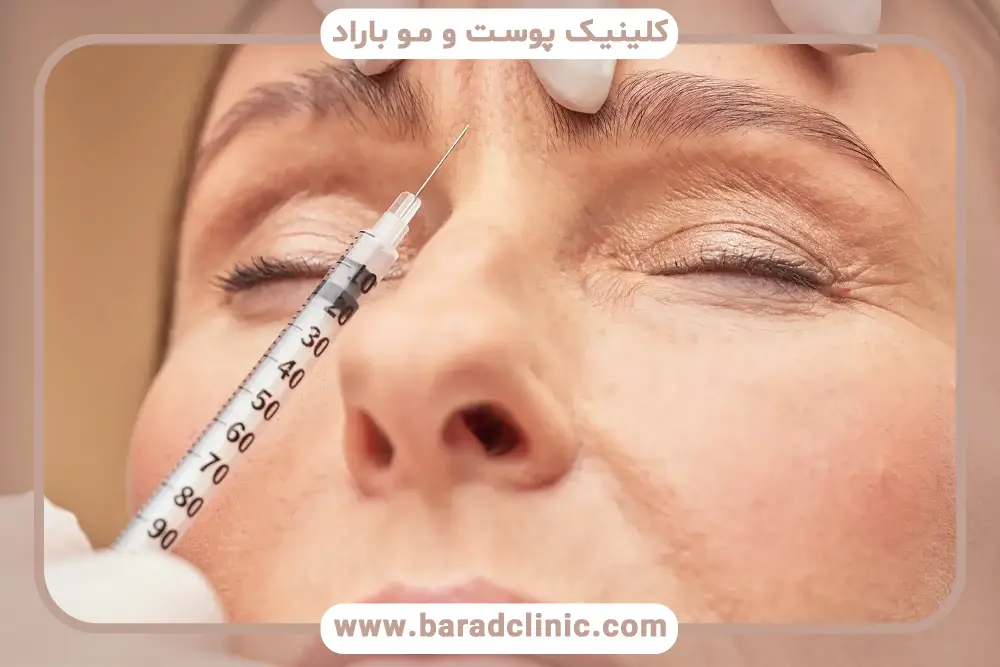 مکانیزم اثر بوتاکس ابرو 