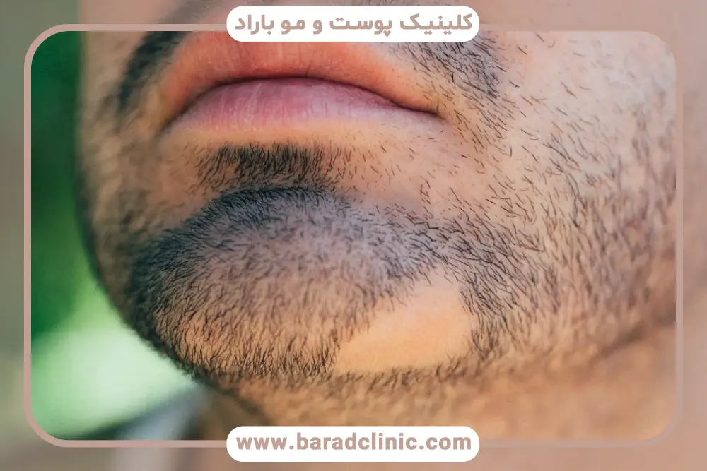 ارتباط ریزش ریش و کمبود ویتامین