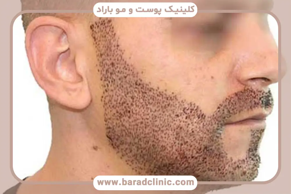 دلایل تورم بعد از کاشت ریش 