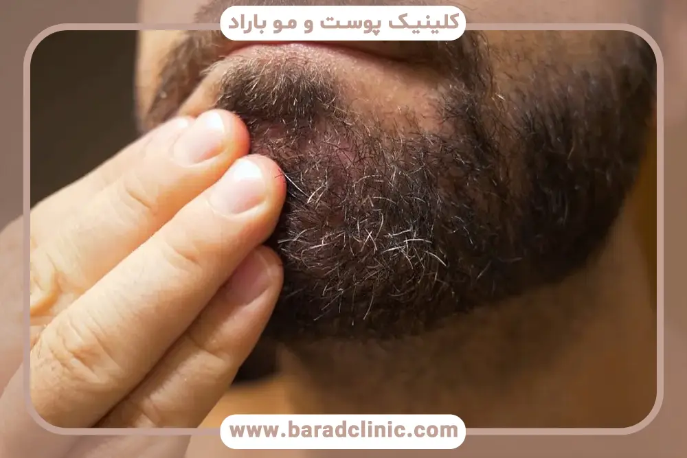 دلایل ریزش ریش همراه با پوسته 