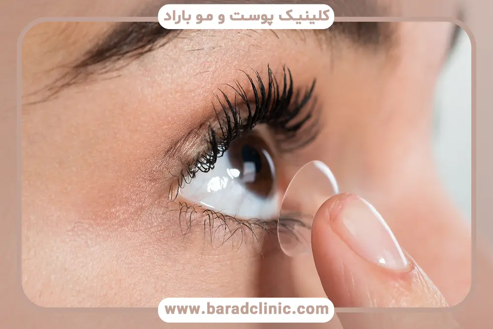 خطرات استفاده زودهنگام از لنز بعد از جراحی بلفاروپلاستی