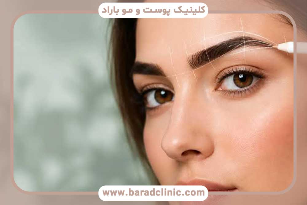 کاشت ابرو