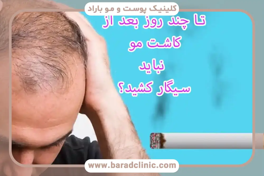 بررسی مدت نکشیدن سیگار بعد از کاشت مو 