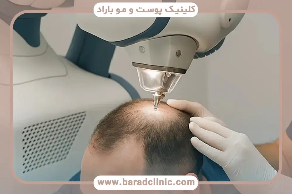 جدیدترین روش کاشت مو بدون درد چیست؟