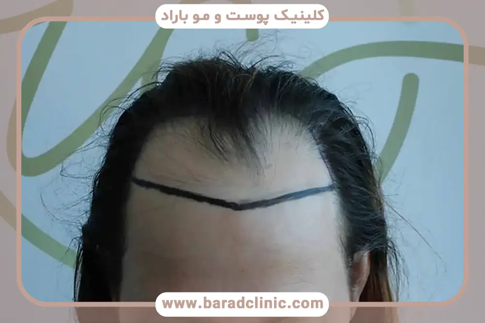 مراحل کاشت مو به روش تکثیر پیاز مو