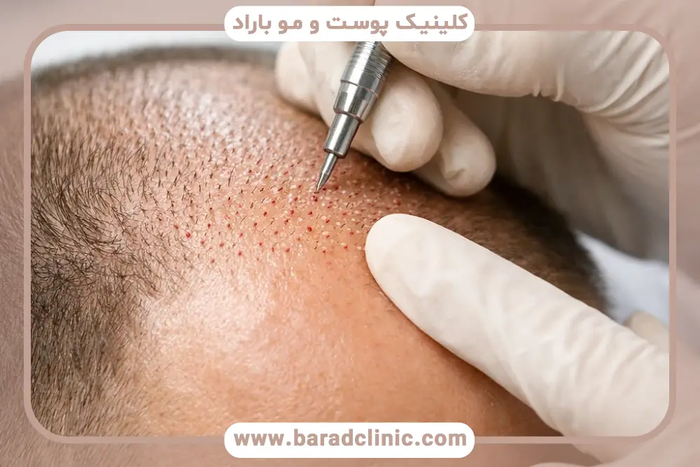 تفاوت کاشت مو به روش sut و fue در نحوه برداشت