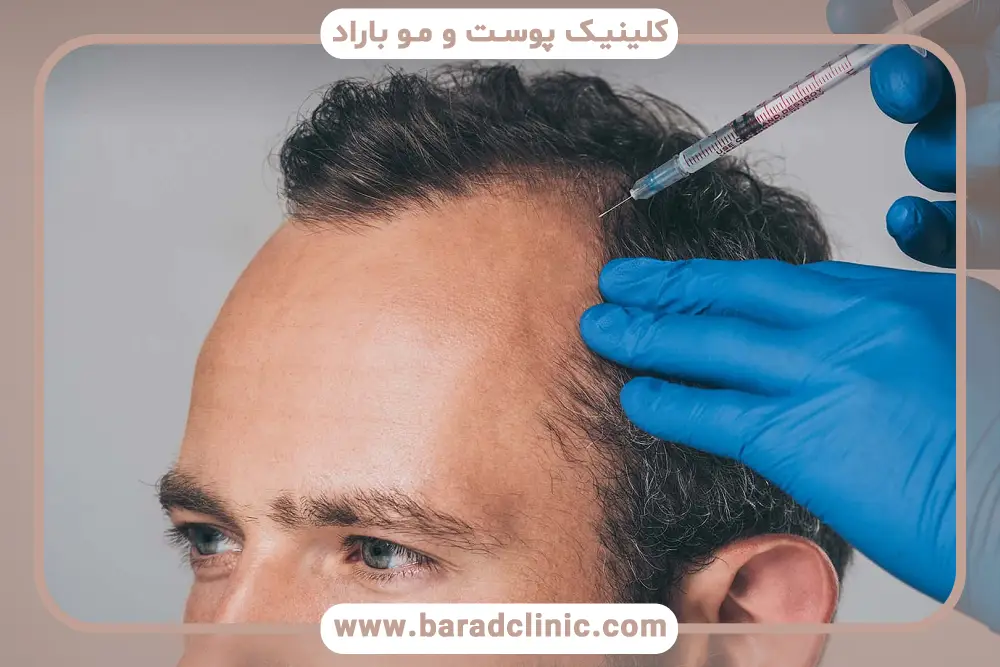 بررسی پی ار پی موی سر بعد از کاشت مو 