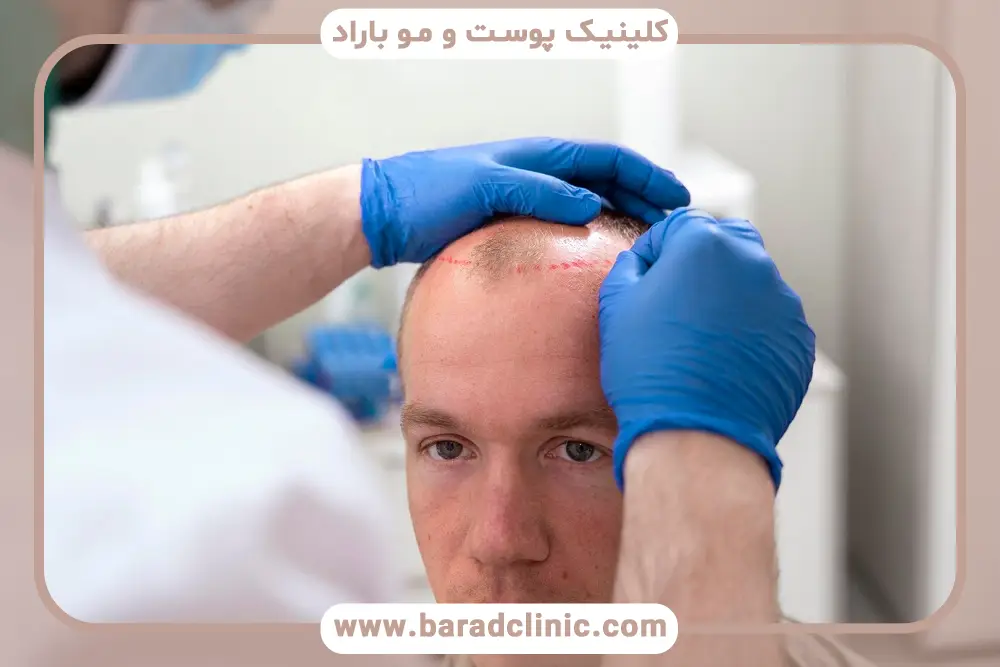 کاشت مو در شیراز بهتر است یا تهران؟ مقایسه کلی