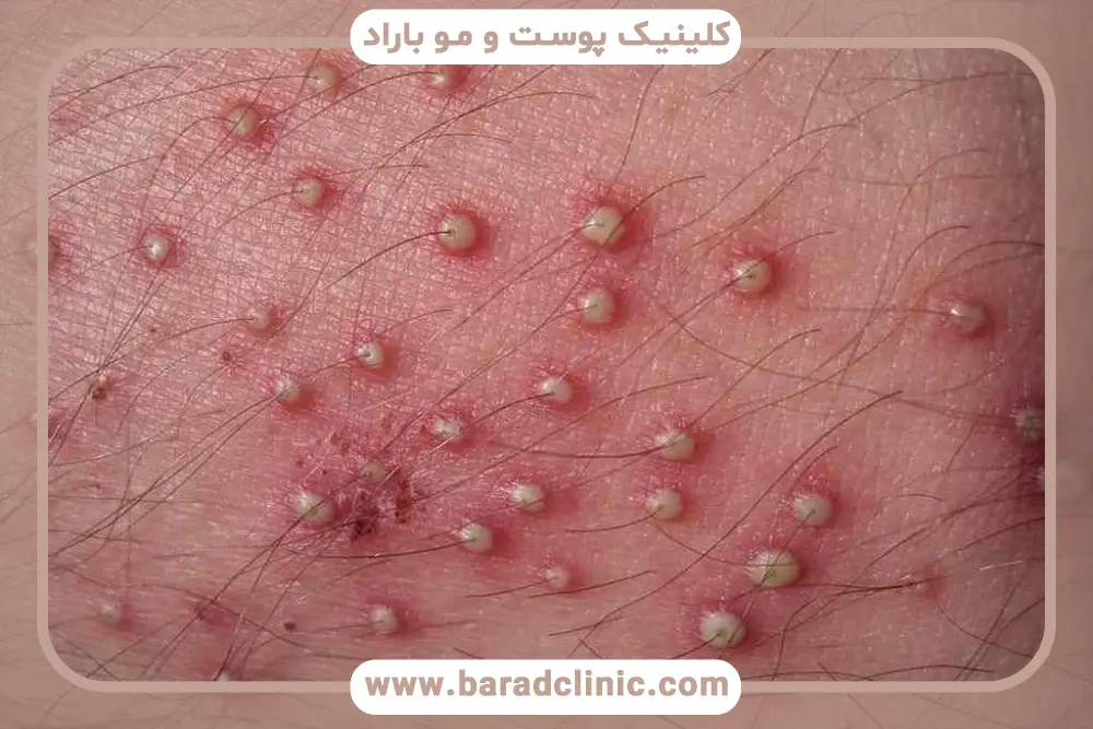 علائم فولیکولیت ریش