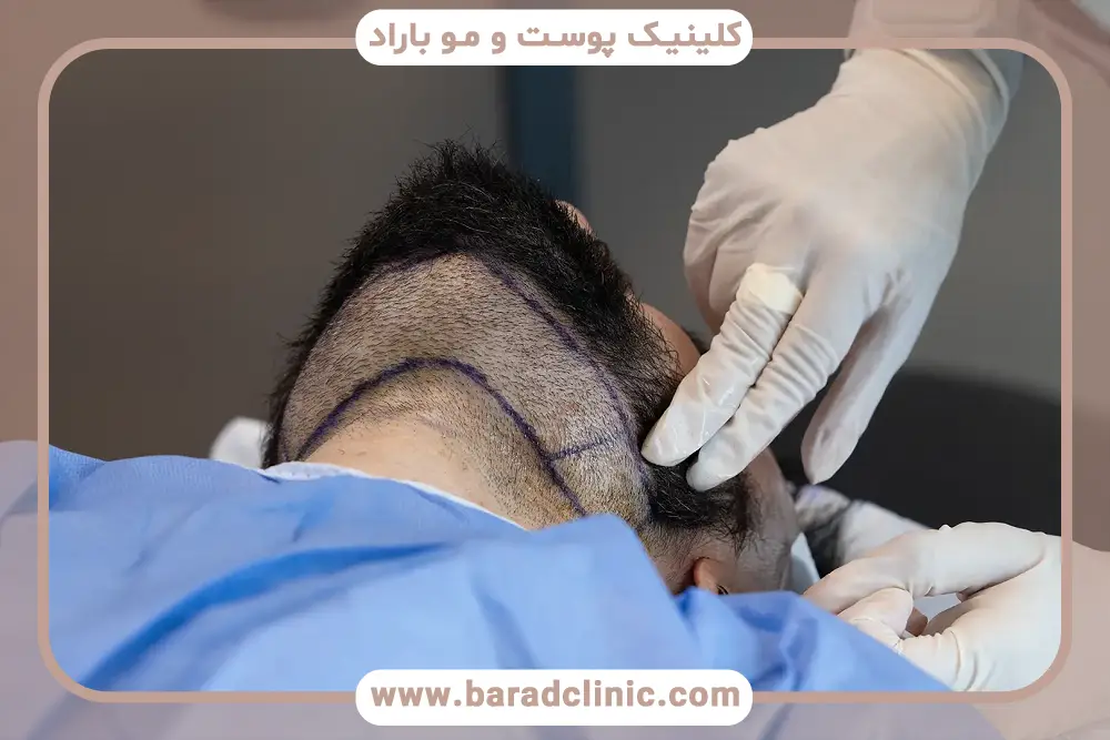 نواحی برداشت در کاشت مو به روش hrt 