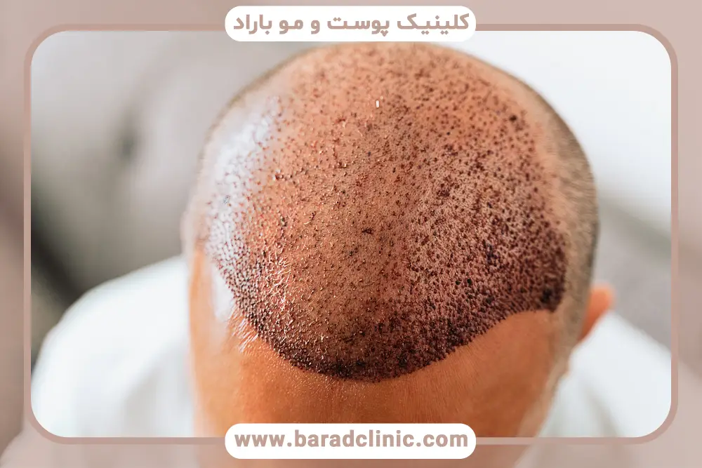 کاندیدای مناسب کاشت مو در دو روز 