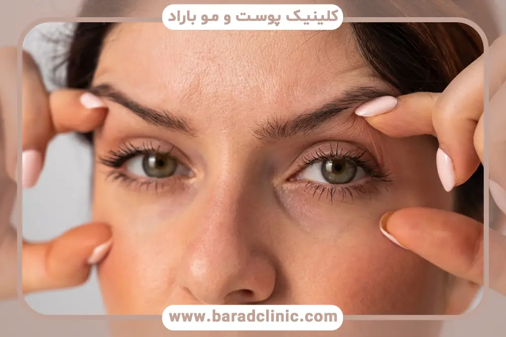 علائم افتادگی پلک چیست؟