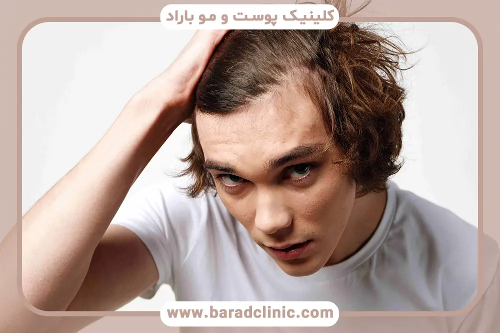 علائم ریزش موی مردان