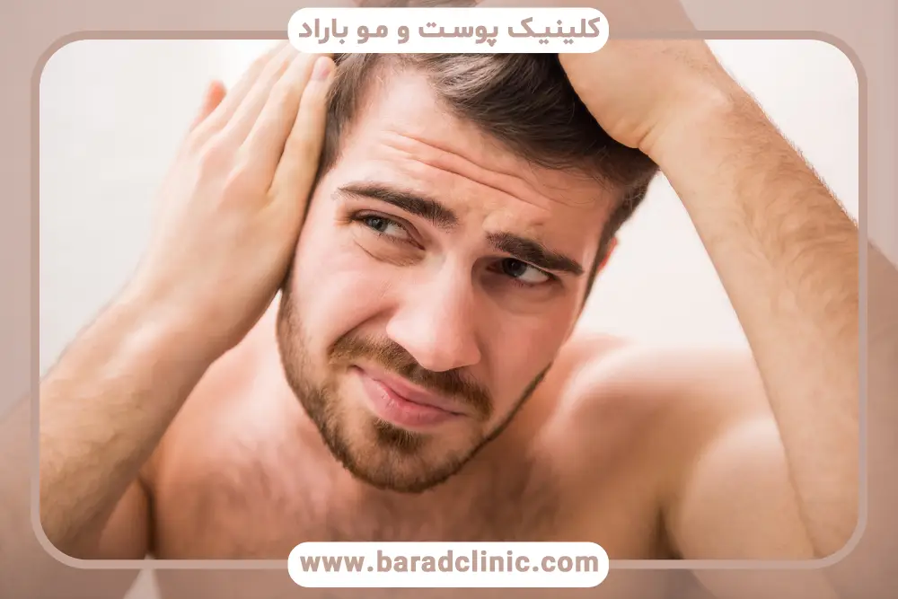 DHT یک علت طاسی مردان 