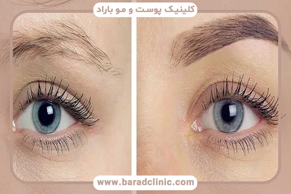 شرایط کاشت ابرو برای افراد مبتلا به آلوپسی