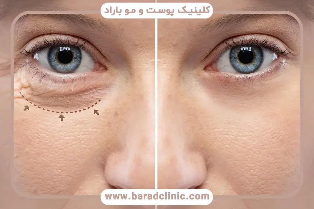 مراحل دوره نقاهت عمل بلفاروپلاستی