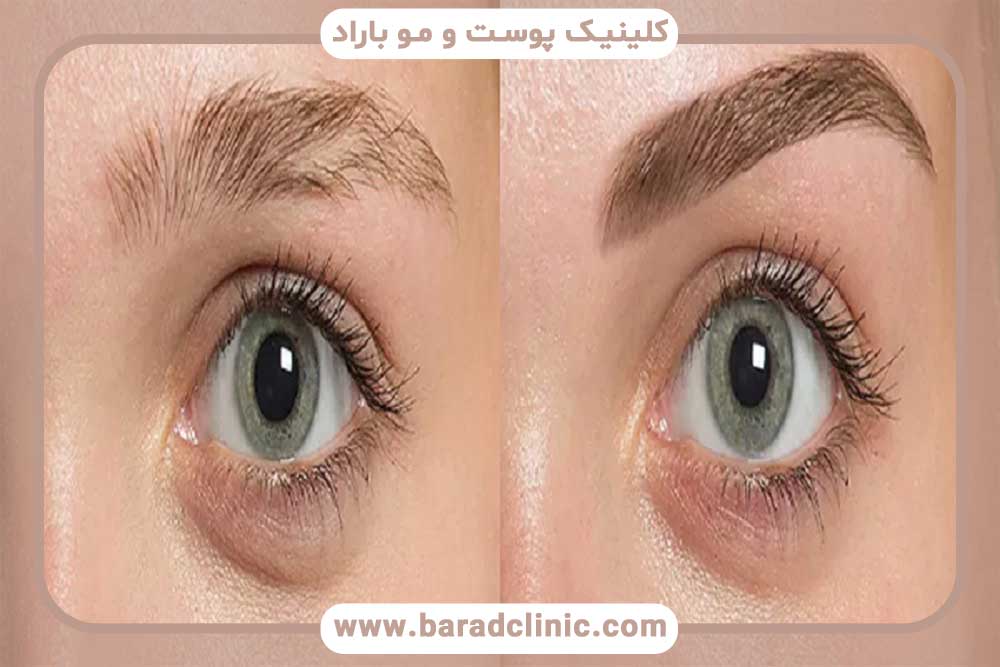 نتیجه کاشت ابرو برای افراد مبتلا به آلوپسی