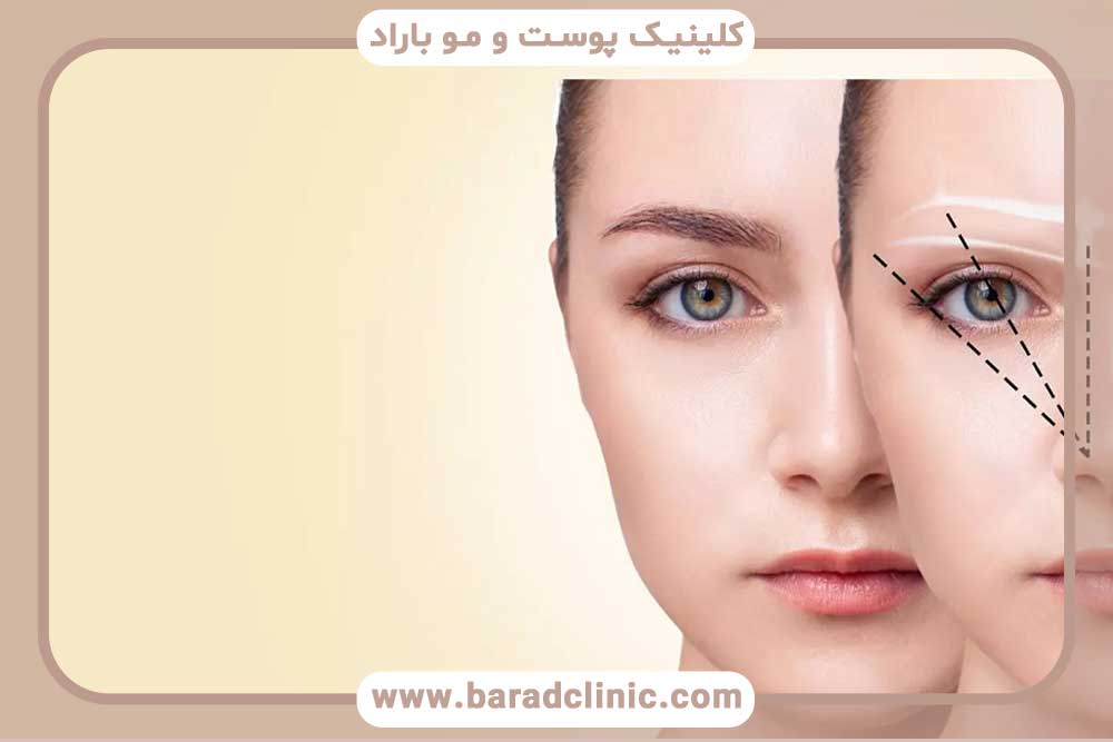 کاشت ابرو بعد از شیمی درمانی