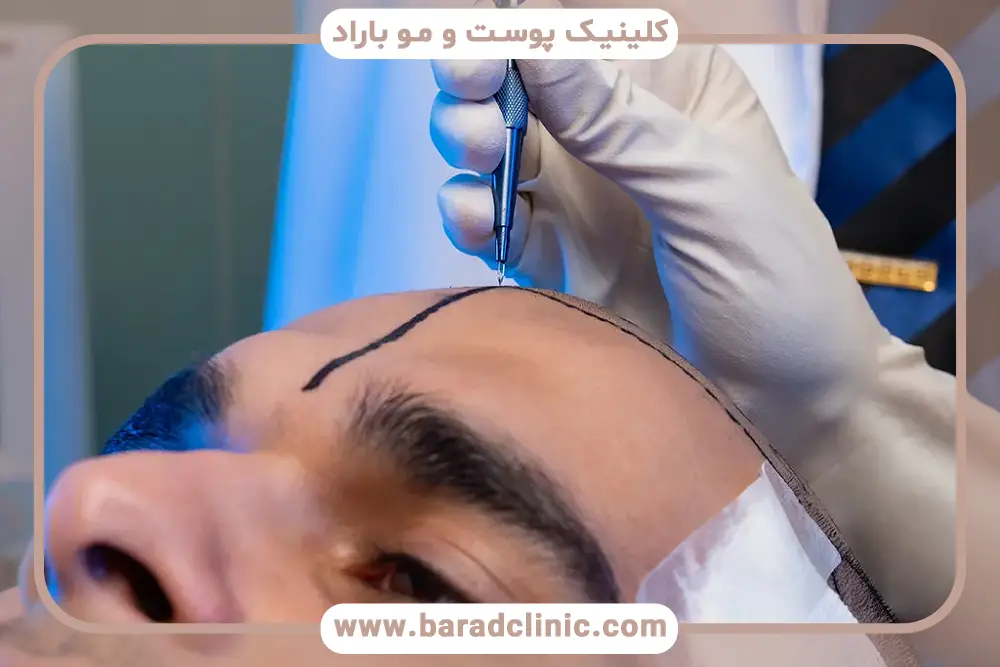 هزینه کاشت مو با دستگاه تمام اتوماتیک تهران