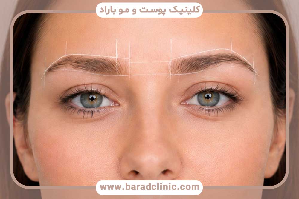 پیوند مو ابرو