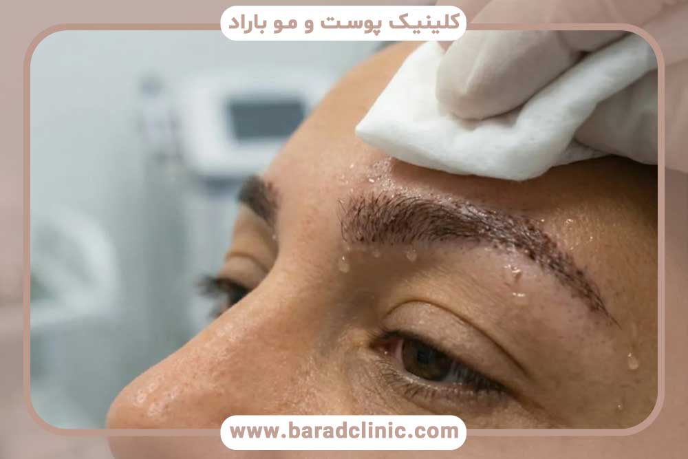 شستشوی ابرو بعد از کاشت