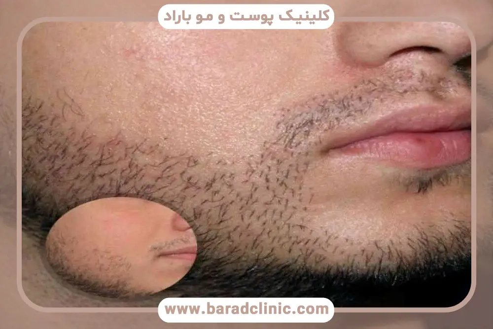 عوامل موثر بر باقی ماندن جای زخم کاشت ریش