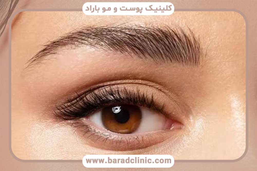 کاشت ابرو با بیهوشی