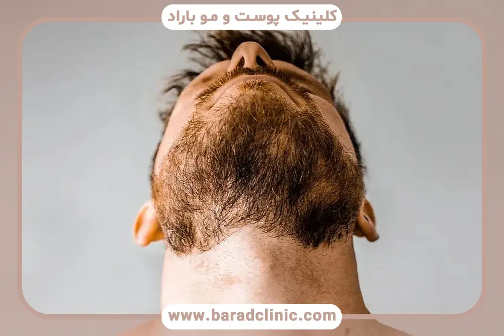 ریزش ریش و کمبود ویتامین، ویتامینهای موردنیاز