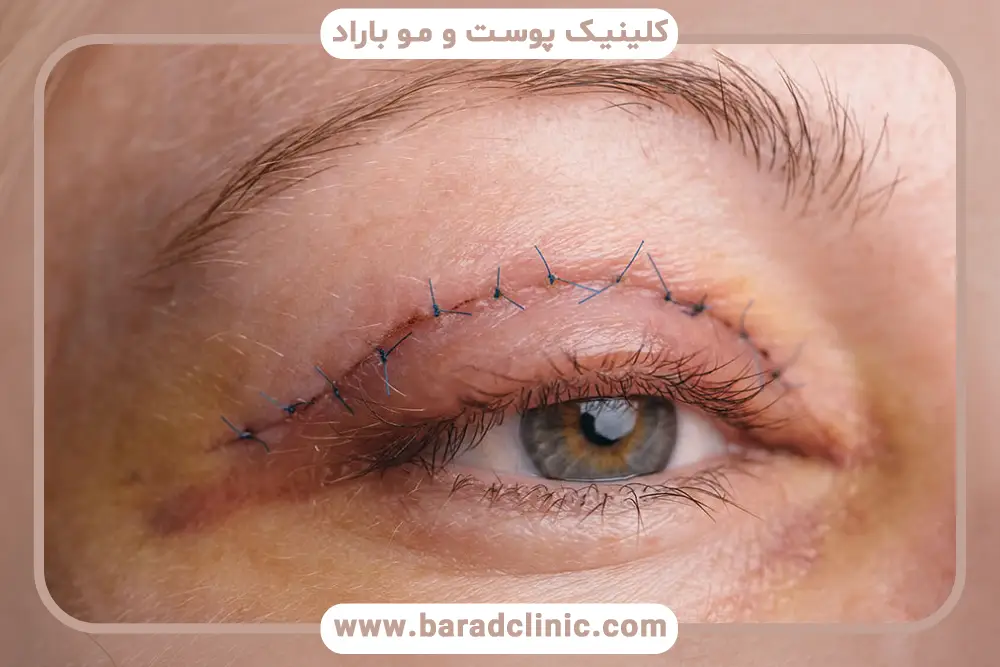 نقش بهترین فصل جراحی بلفاروپلاستی در کاهش اشعه فرابنفش