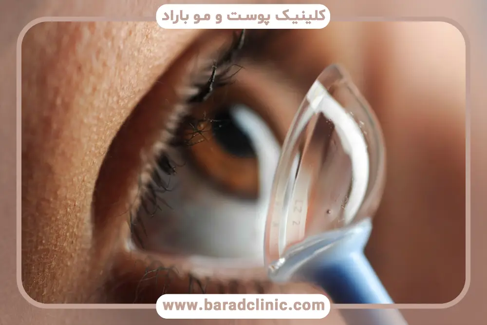 مدیریت خشکی چشم در استفاده از لنز بعد از جراحی بلفاروپلاستی