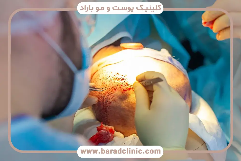 مزایای جدیدترین روش کاشت مو بدون درد 