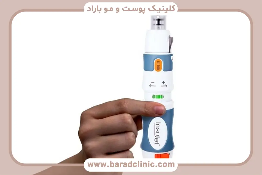 مزایا و معایب کاشت مو بدون سوزن بی حسی 