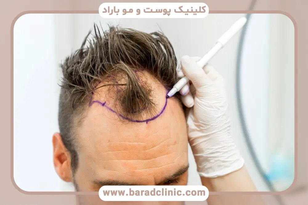 تفاوت کاشت مو به روش sut و fue در میزان تراکم