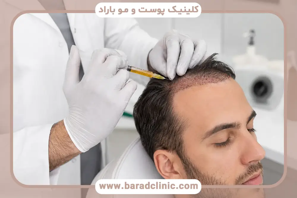 زمان شروع پی ار پی موی سر بعد از کاشت مو 