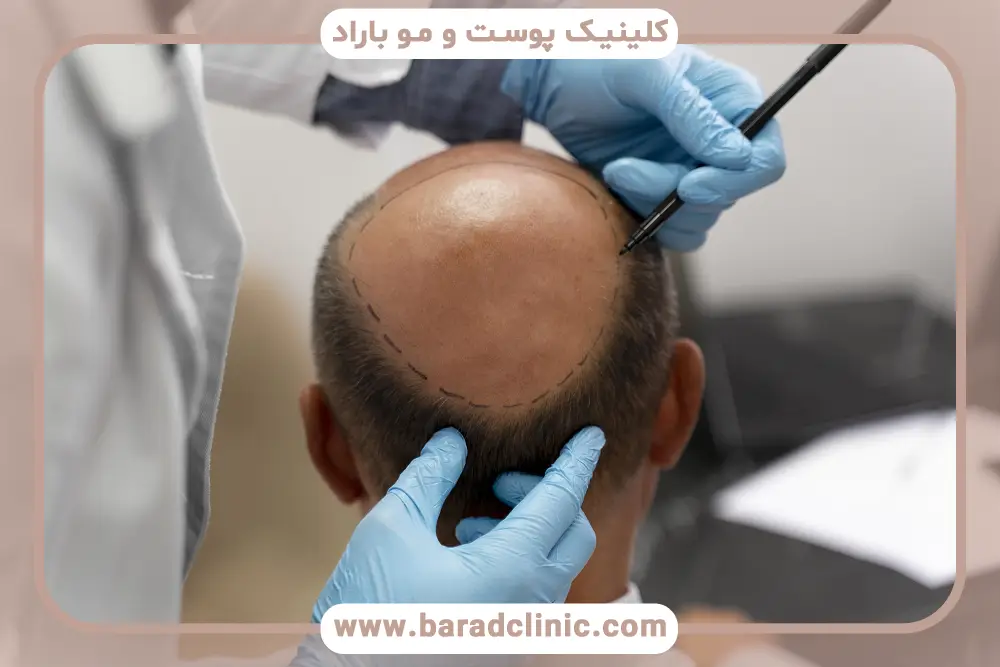 کاشت مو در شیراز بهتر است یا تهران؟ مقایسه تنوع تکنیک‌ها
