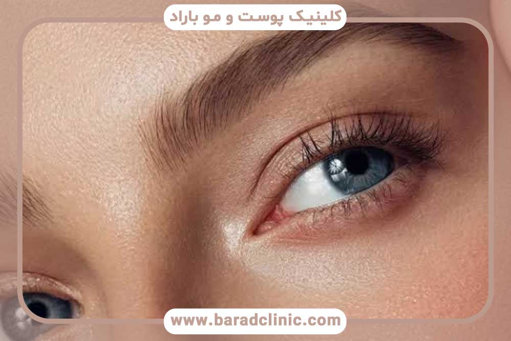 هزینه کاشت ابرو