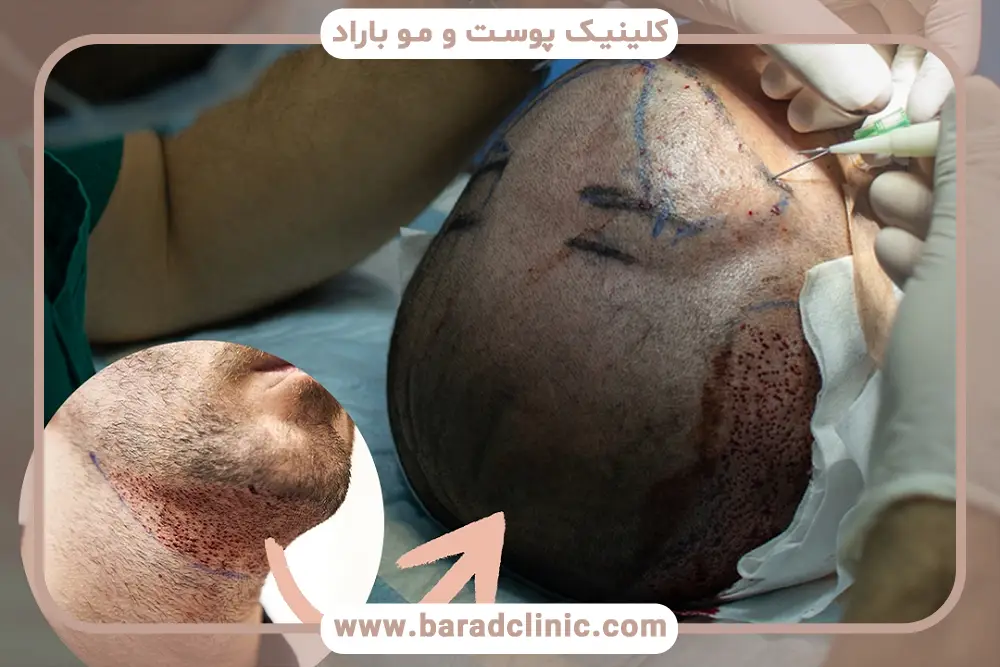 مراحل کاشت مو به روش hrt 